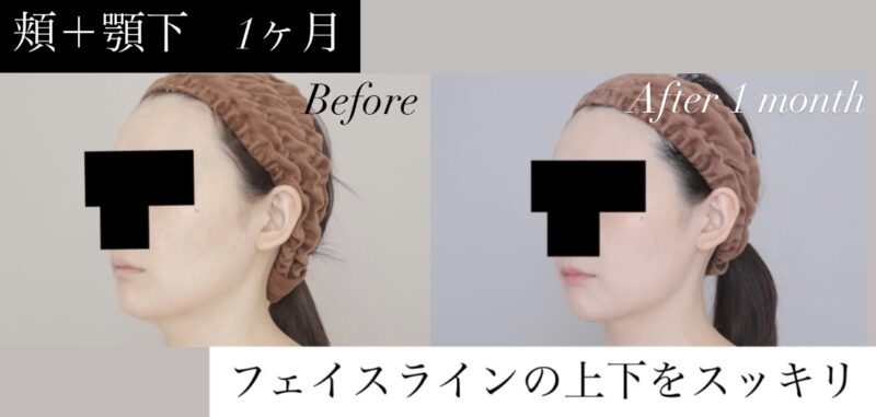 ●【頬＋顎下】30代女性 161cm 54kgのモニター様●