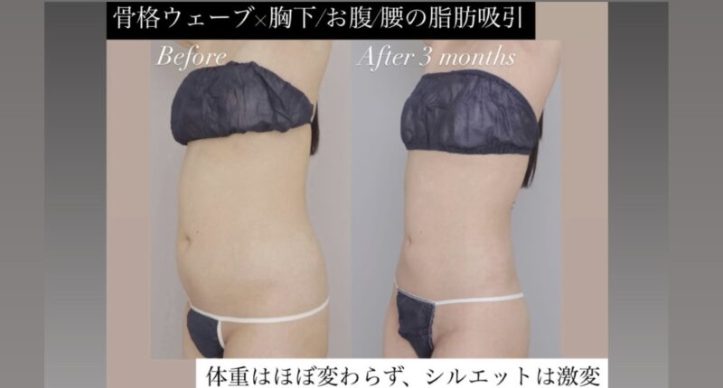 ●骨格ウェーブ×胸下＋腹＋腰の脂肪吸引 (20代女性 153cm 50kg)