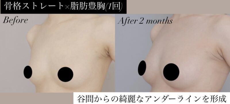 ●骨格ストレート×脂肪豊胸（1回） (30代女性 152cm 49kg)