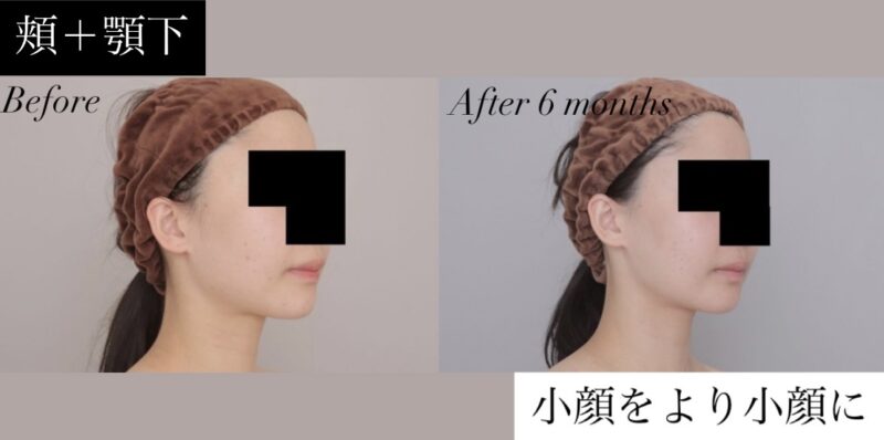 ●【頬＋顎下】20代女性 150cm 47kgのモニター様●
