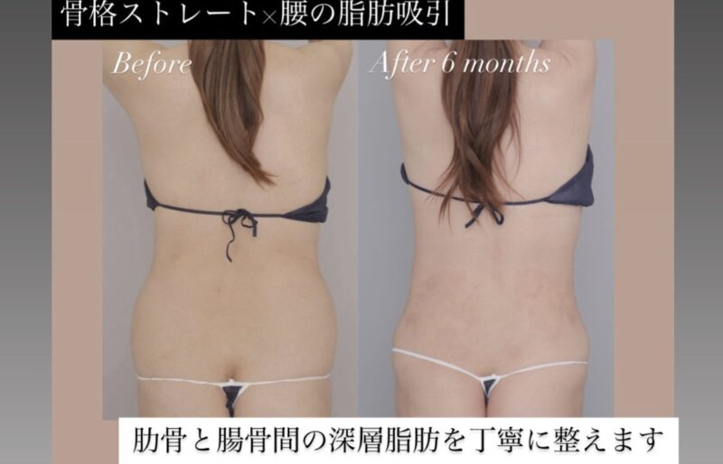 ●骨格ストレート×胸下+腹部全体＋腰の脂肪吸引 (50代女性 163cm 72kg )