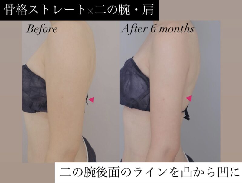●【二の腕・肩】20代女性(骨格ストレート) 160cm 50kg  女性モニター様●