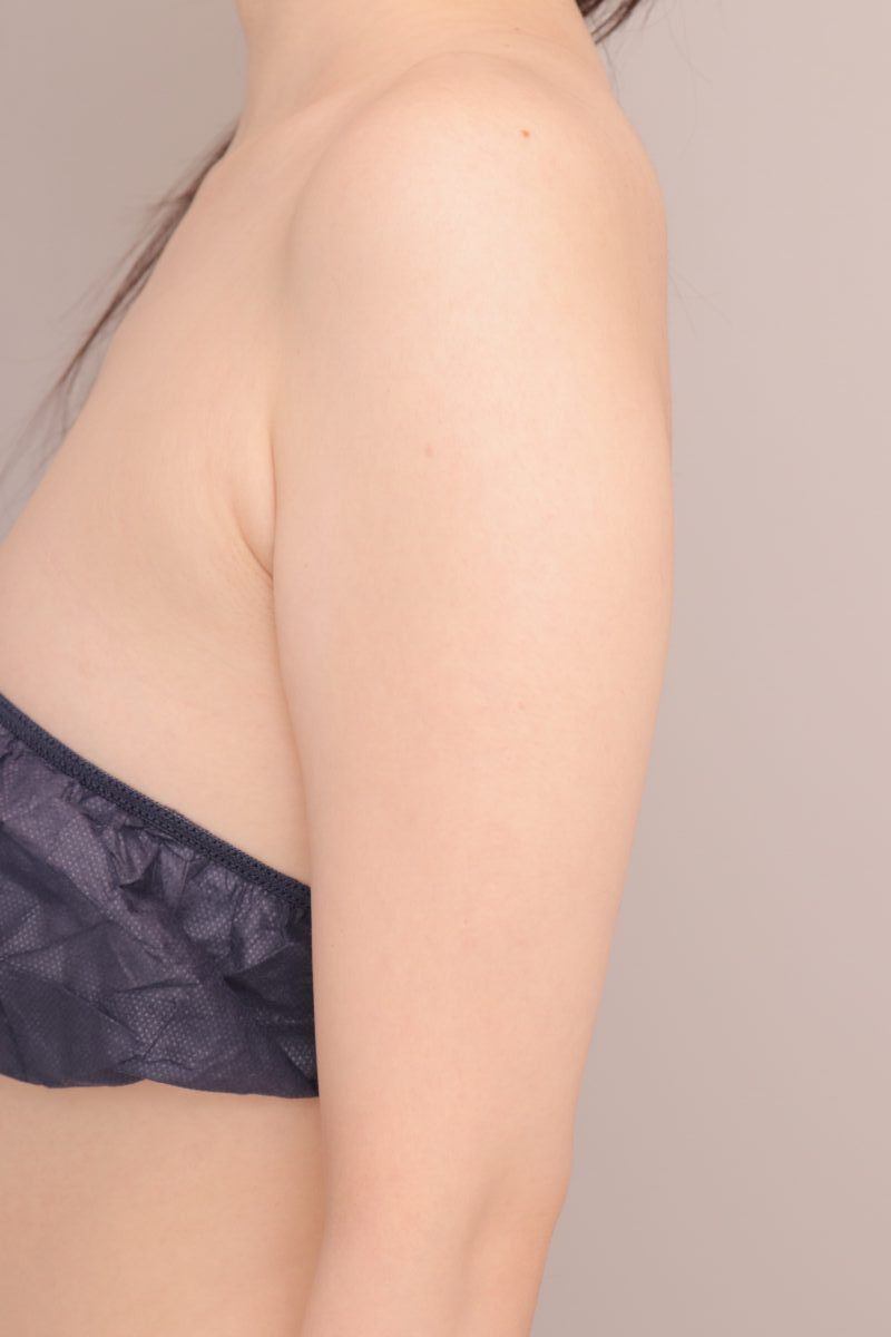 ベイザー脂肪吸引（半年経過：24）の術前写真