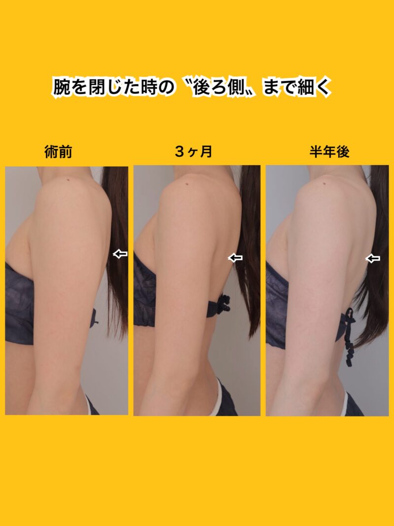 時系列、腕を閉じたときの後ろ側まで細く~163cm47kg上腕肩脇肉400cc吸引後3か月半年~