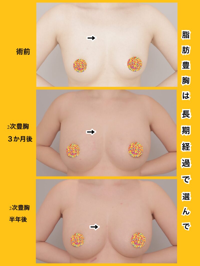 大きくなるだけでなく、綺麗な谷間までこだわる~40歳162cm56kg脂肪豊胸(CRF豊胸)時系列2次豊胸後3か月半年~