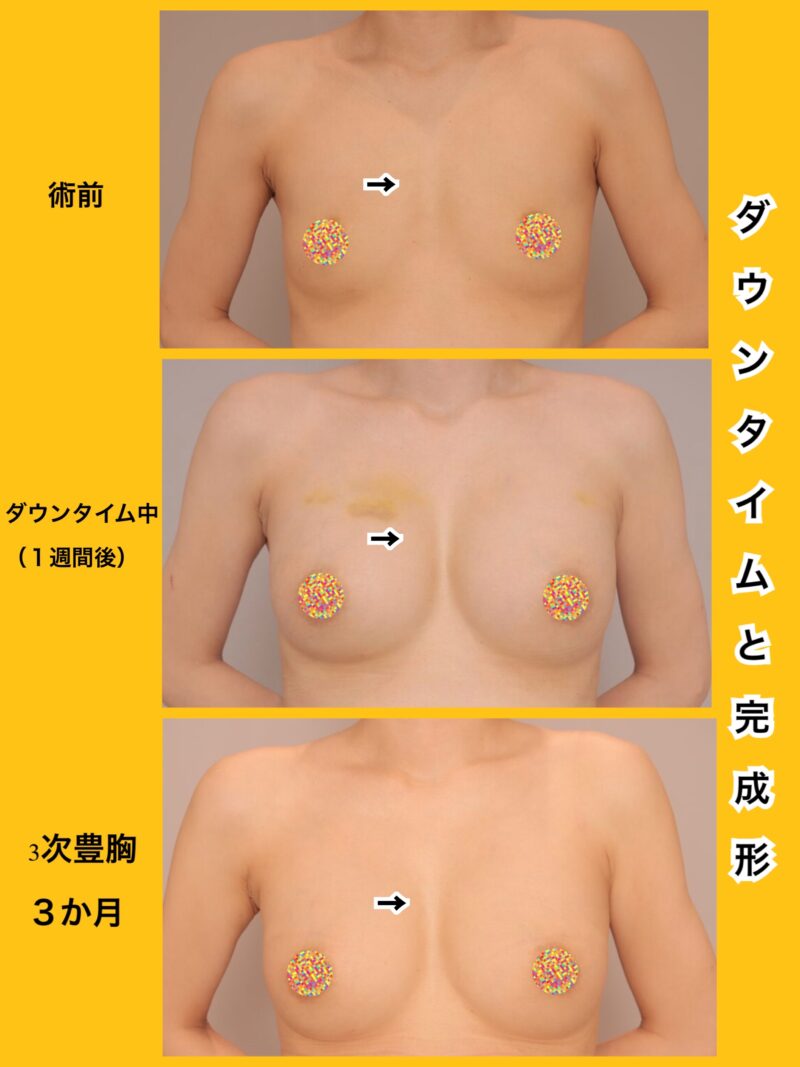 ダウンタイムと完成形をお見せします。~40歳163cm45kg脂肪豊胸(CRFバスト)3次豊胸後1週間後、3か月~