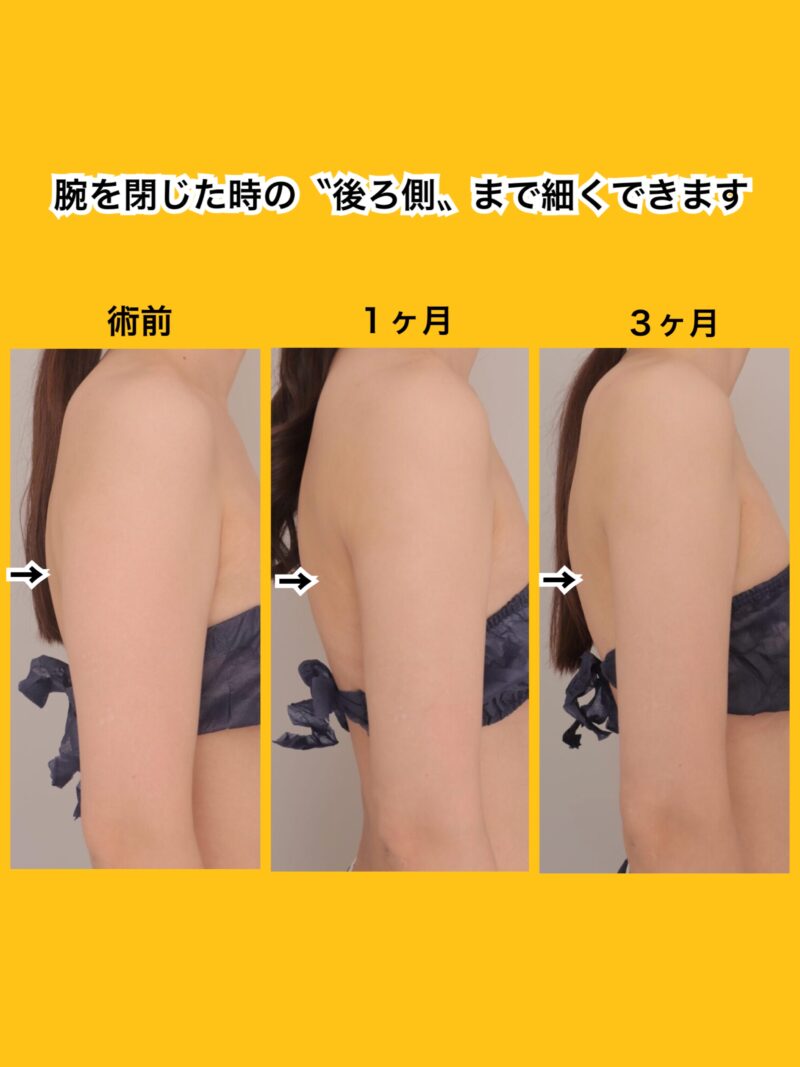 時系列でお見せします!後ろ側まで細くなる時間経過。~32歳162㎝53㎏上腕肩脇肉800cc吸引後1,3ヶ月~