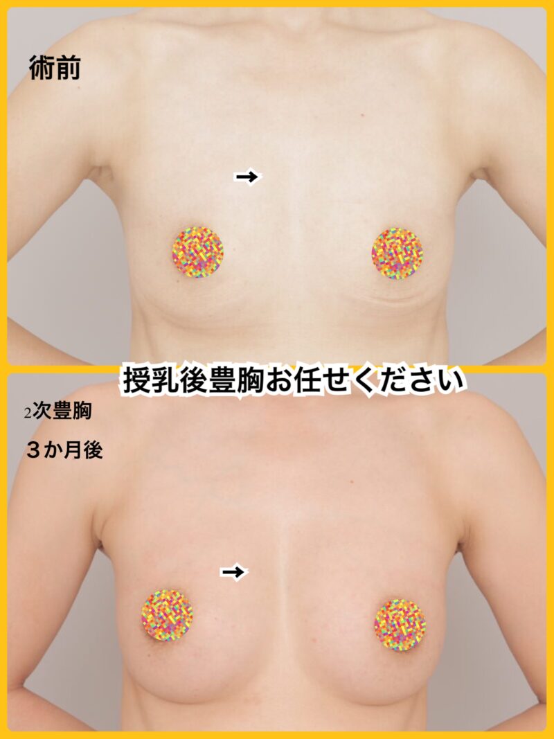 授乳後のお胸を、授乳前よりも〝美しく〟できます。~37歳163cm50kg脂肪豊胸(CRFバスト)2回目後3か月~