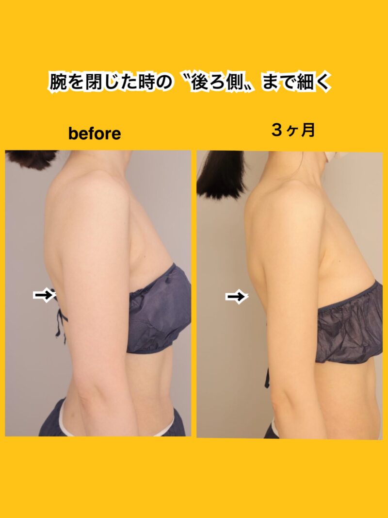 細身の方も更に細くできます。~34歳160cm51kg上腕全周脇肉700cc吸引後3か月~