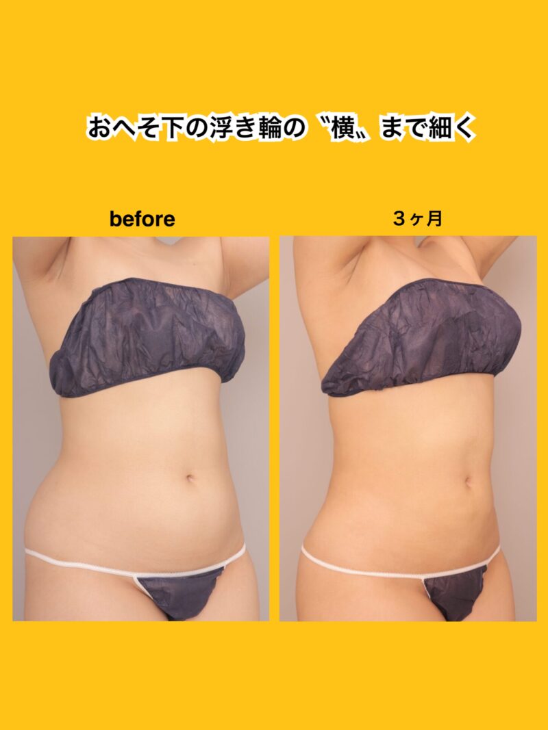 おへそ下の浮き輪の〝横〟まで細く。BMI高めの方も細くできます~25歳148cm57kg 腹部全体胸下腰吸引脂肪豊胸後3か月~