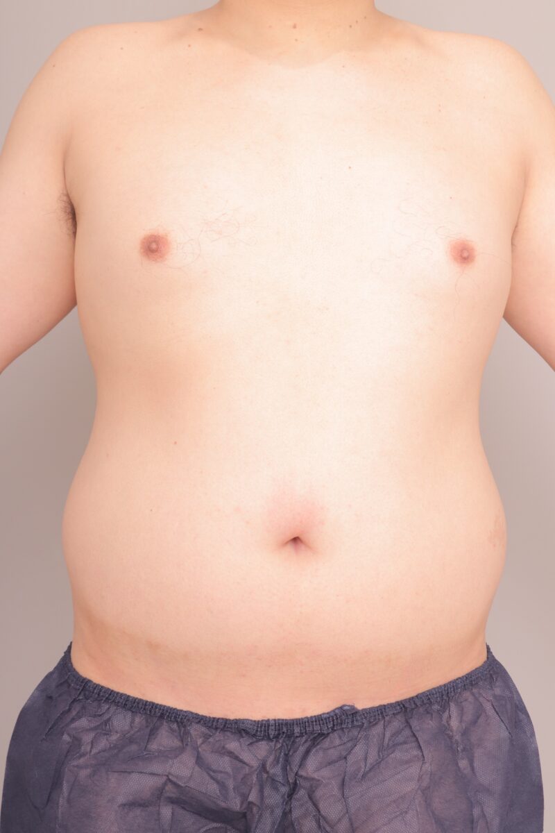 ベイザー脂肪吸引（半年経過：46）の術前写真