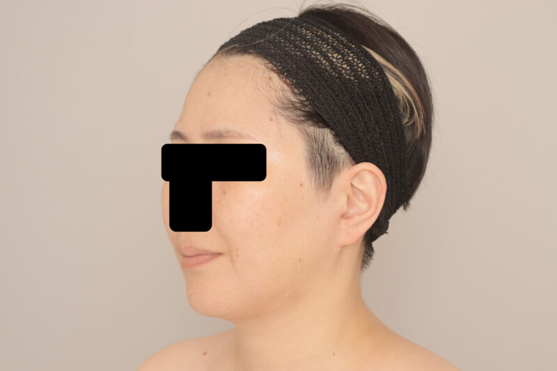 ベイザー脂肪吸引(1ヶ月経過:45)の術後写真