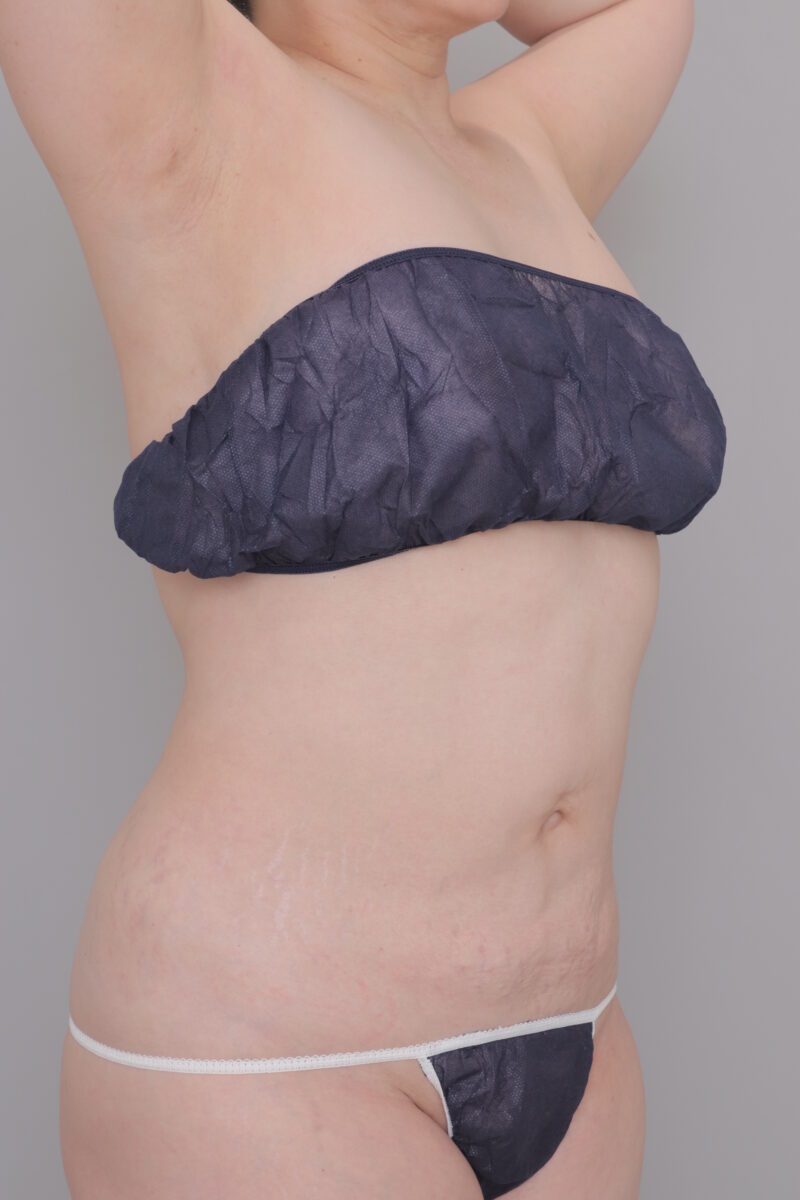 【最高難易度】50代女性のお腹まわり激変・大量吸引（3ヶ月）●