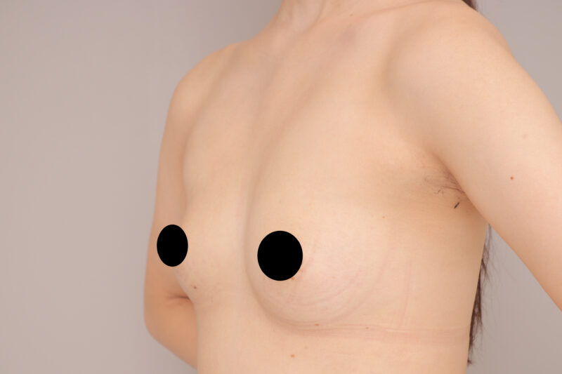 ベイザー脂肪吸引（10か月後経過：28）の術前写真