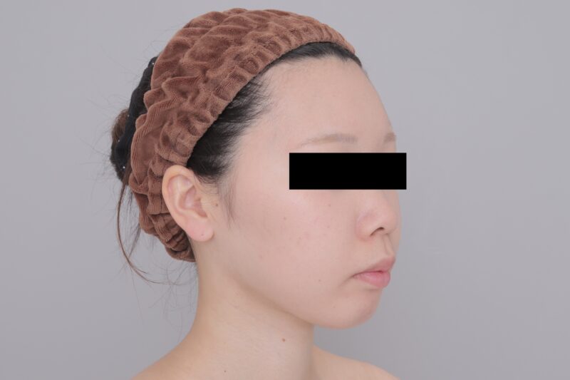 ベイザー脂肪吸引(3ヶ月経過:23)の術後写真