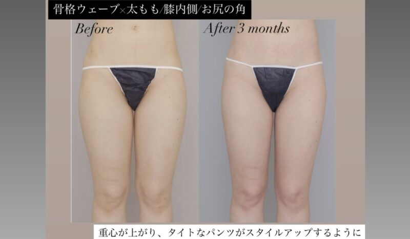 ●骨格ウェーブ×太腿全周+膝＋臀部の脂肪吸引 (20代女性 157cm 54kg)