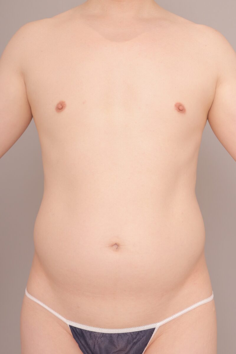 ベイザー脂肪吸引(半年後経過:44)の術前写真