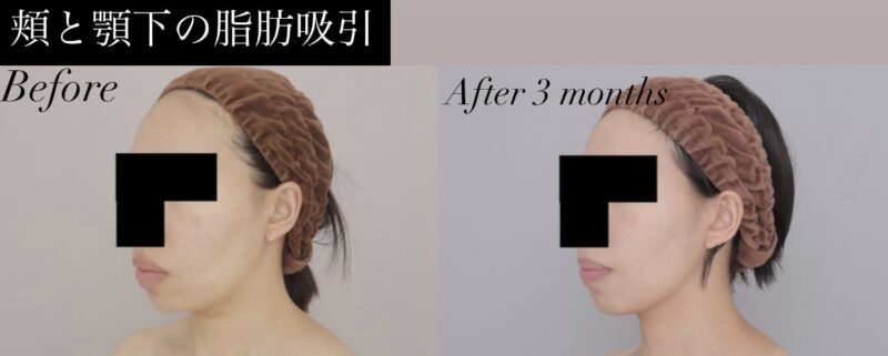 ●【頬＋顎下】30代女性 157cm 45kgのモニター様