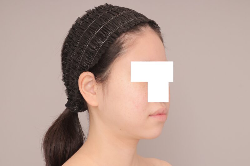 ベイザー脂肪吸引(6ヶ月経過:36)の術前写真