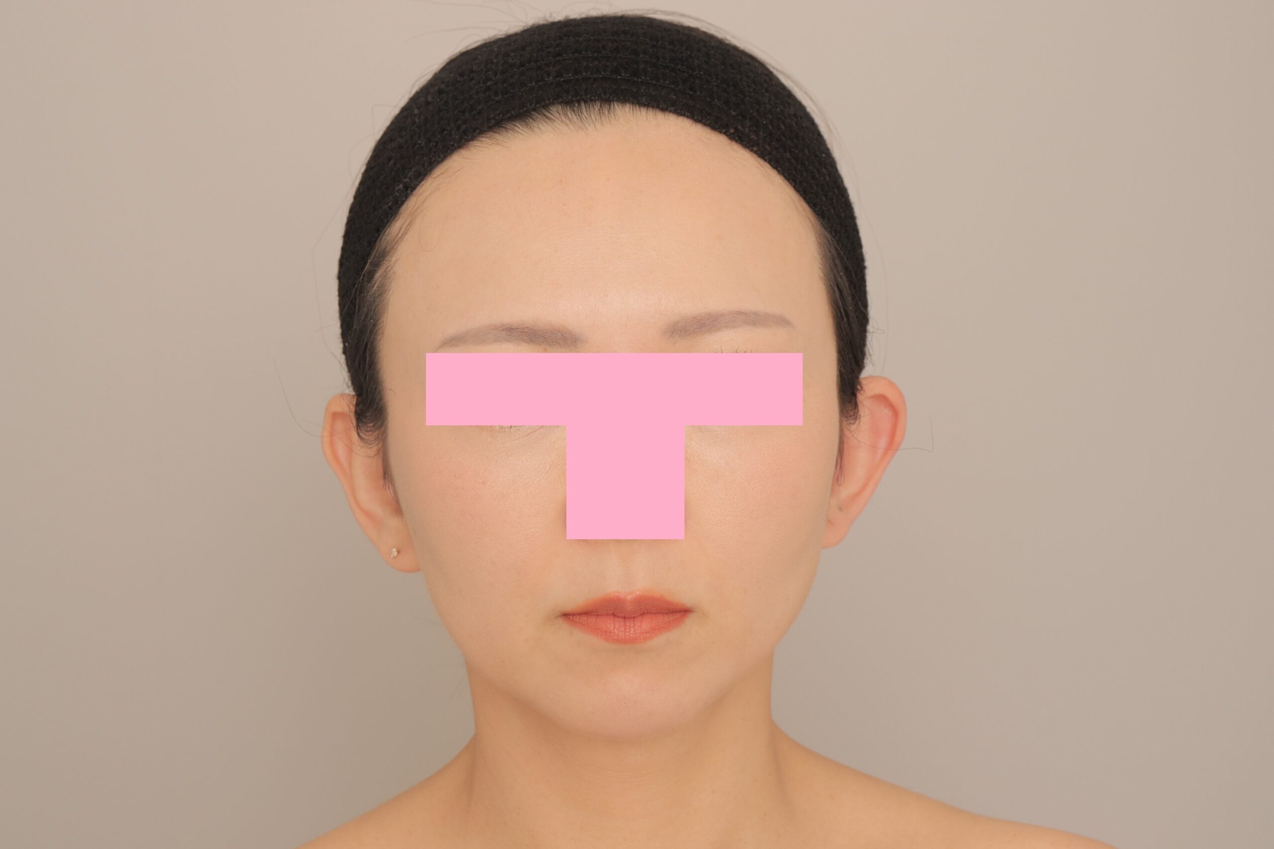 頬顎下脂肪吸引でフェイスラインを美しく。モニター様の6か月経過をご紹介♪　36歳 158cm 61kg