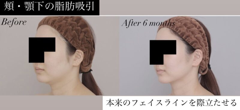 ●【頬＋顎下】20代女性 160cm 52kgのモニター様