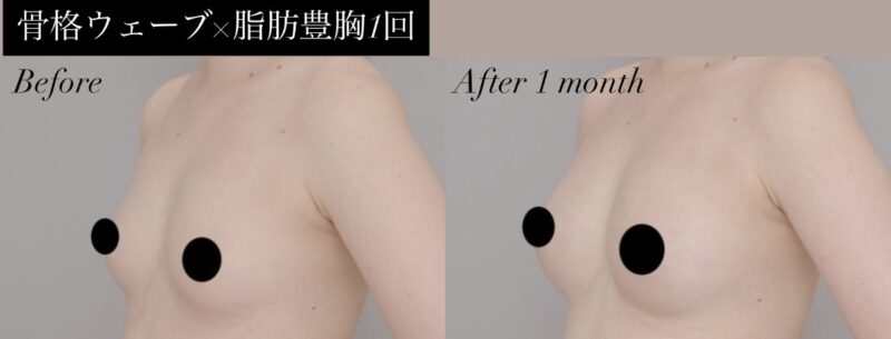 ●【骨格ウェーブ×脂肪豊胸(1回) 術後1か月】20代 163㎝ 53kgモニター様