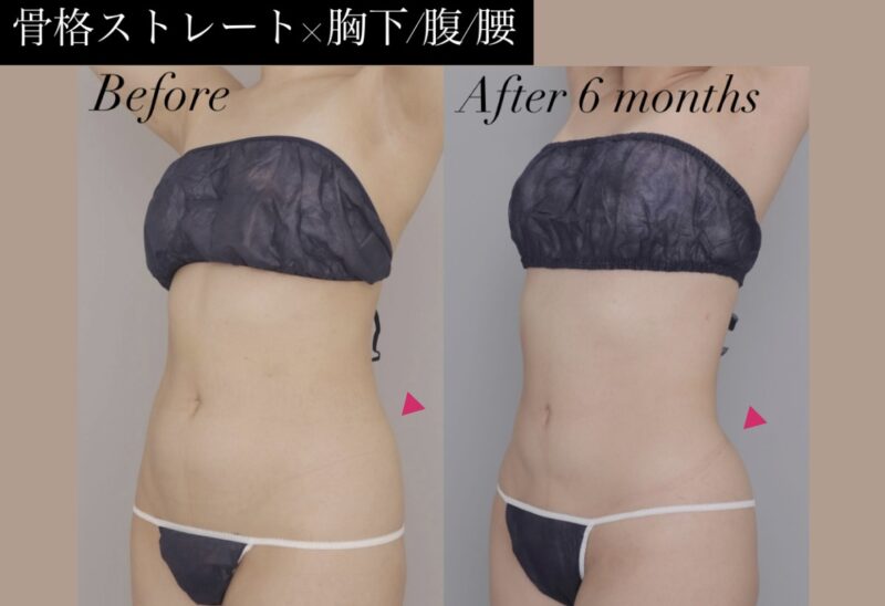 ●【骨格ストレート×胸下・腹・腰の脂肪吸引】20代女性 145cm 50kg モニター様●