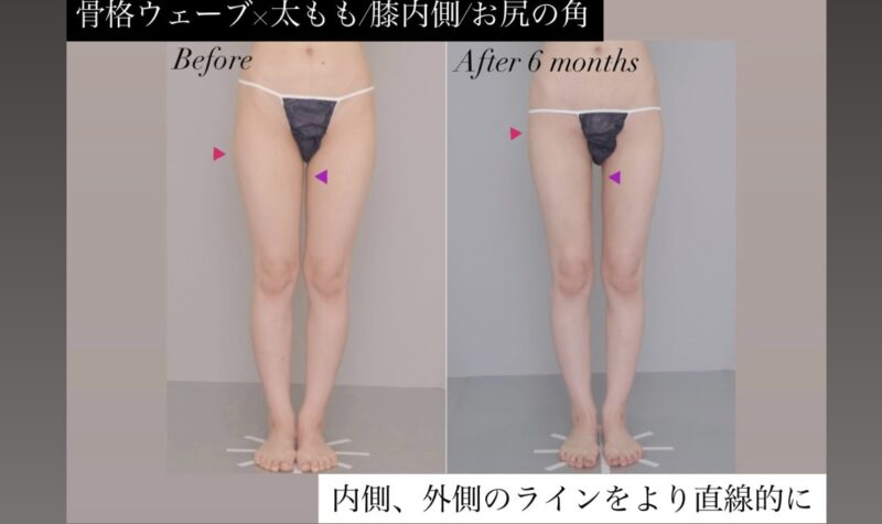 ●骨格ウェーブ×太腿全周+膝＋臀部の脂肪吸引 (30代女性 155cm 45kg)