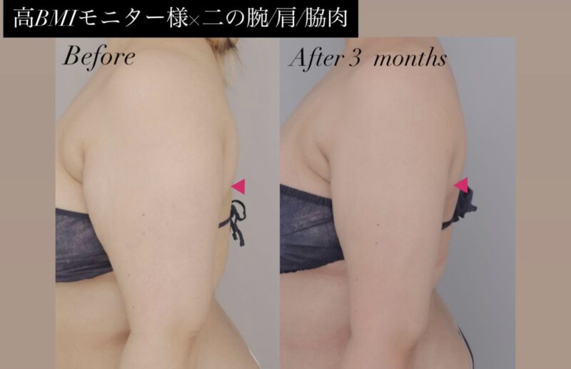 ●【高BMIモニター様×上腕全周・脇肉】30代女性 156cm 78kg （BMI32）