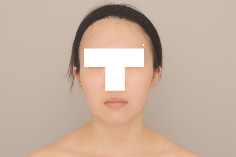 ベイザー脂肪吸引(半年経過:24)の術前写真