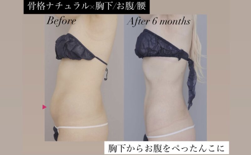 ●骨格ナチュラル×胸下＋腹＋腰 （術後6ケ月）20代女性 160cm 54kg のモニター様