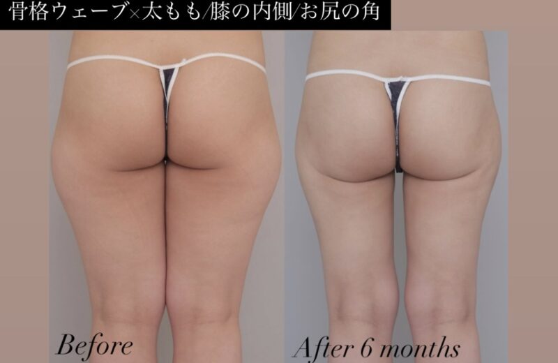 ●骨格ウェーブ×太腿全周+膝＋臀部の脂肪吸引 (20代女性 152cm 47kg)