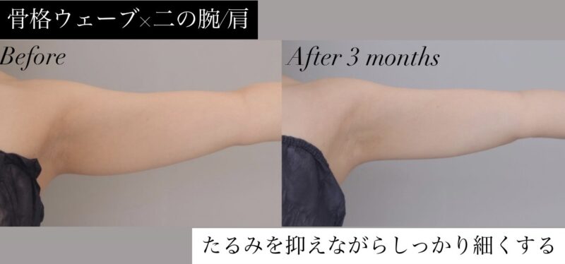 ●【骨格ウェーブ×二の腕・肩】20代女性のモニター様