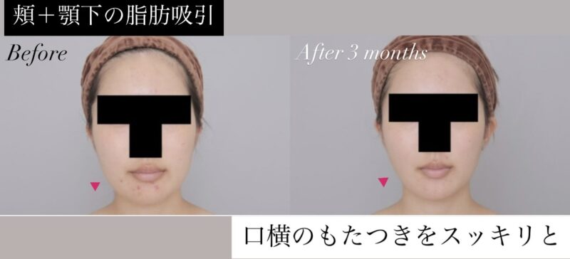 ●【頬＋顎下】20代女性 155cm 49kgのモニター様