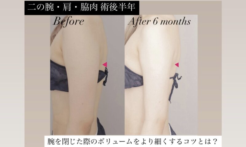 ●【骨格ウェーブ×二の腕・肩・脇肉】20代女性 159cm 46kgのモニター様