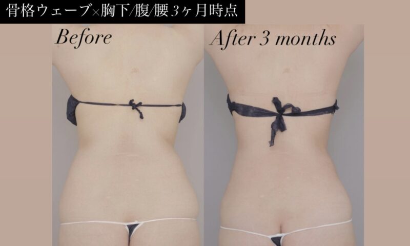 ●骨格ウェーブ×胸下/腹/腰 （術後3ケ月）30代女性 171cm 76kg のモニター様