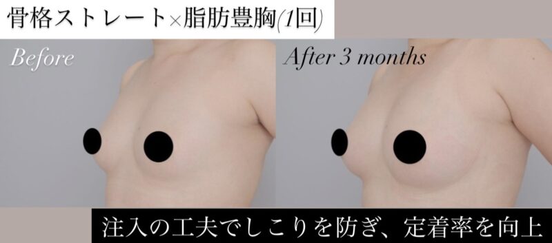 ●【骨格ストレート×脂肪脂肪豊胸(1回)  術後3か月】20代 150㎝ 55kgモニター様