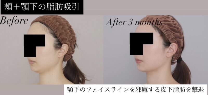 ●【頬＋顎下】30代女性 160cm 56kgのモニター様