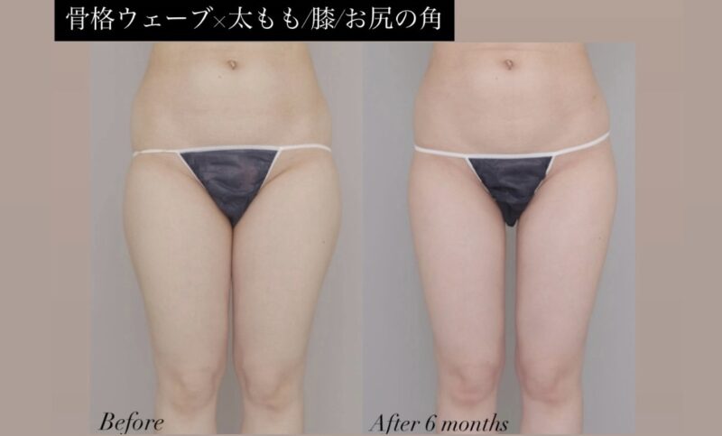 ●骨格ウェーブ×太腿全周+膝＋臀部の脂肪吸引 (20代女性 160cm 57kg)