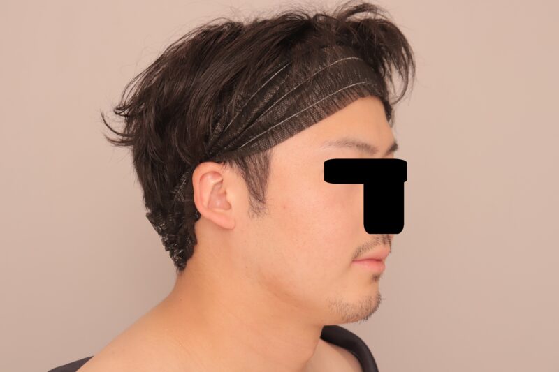 男性の頬顎下吸引~27歳173cm78㎏頬顎下吸引後3か月~