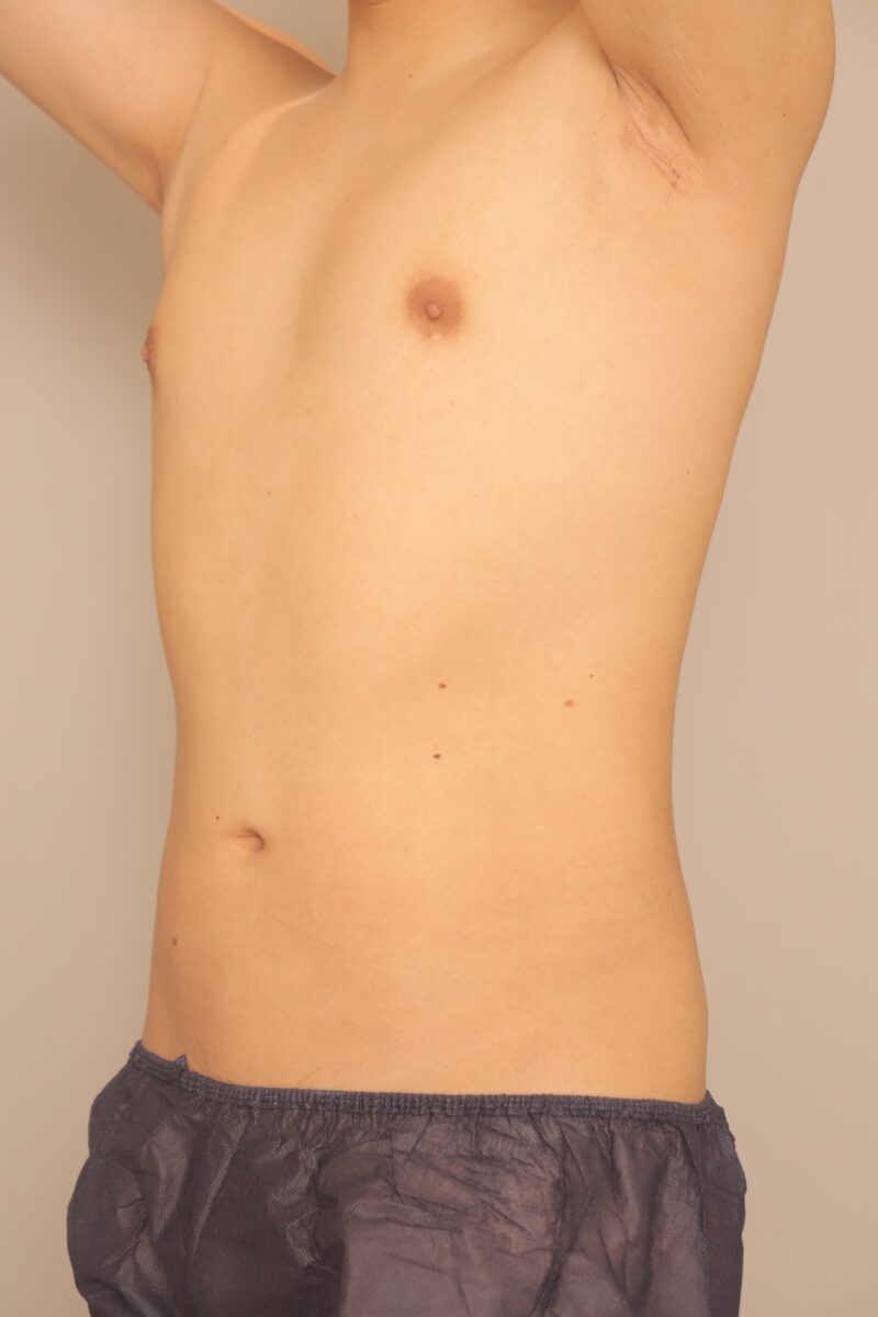 男性のお腹もできます。腹腰吸引お任せください~30歳170cm74kg腹部全体胸下腰1400㏄吸引後半年~