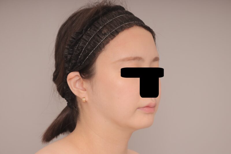 お顔の脂肪吸引。フェイスライン理想に。~35歳159㎝58㎏頬顎下30㏄吸引後半年~