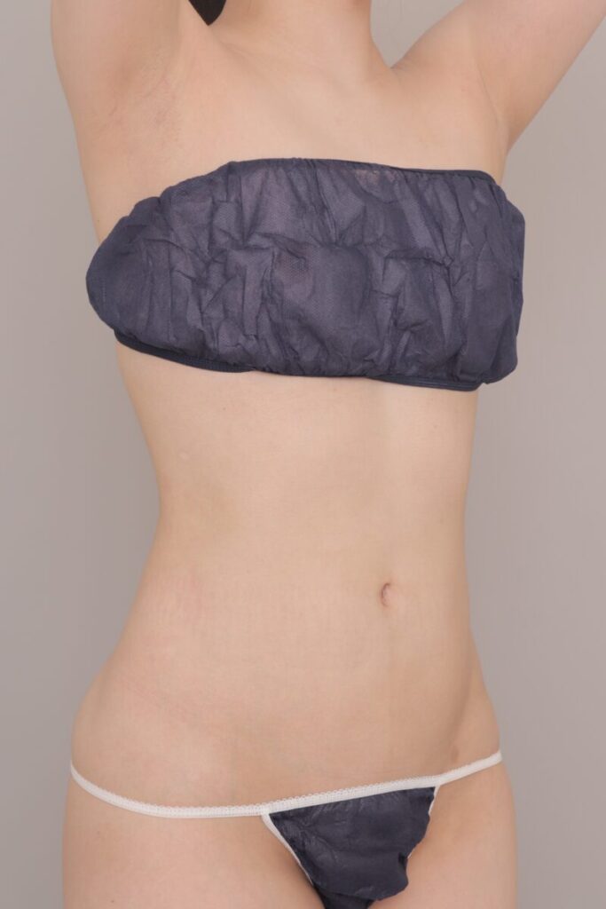 お腹周りすっきり。お任せください。実は腰までしっかり吸引するのがポイントです ~23歳150cm44kg腹部全体胸下腰1800㏄吸引後半年~