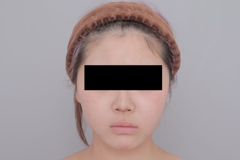 ベイザー脂肪吸引(1ヶ月経過:19)の術後写真