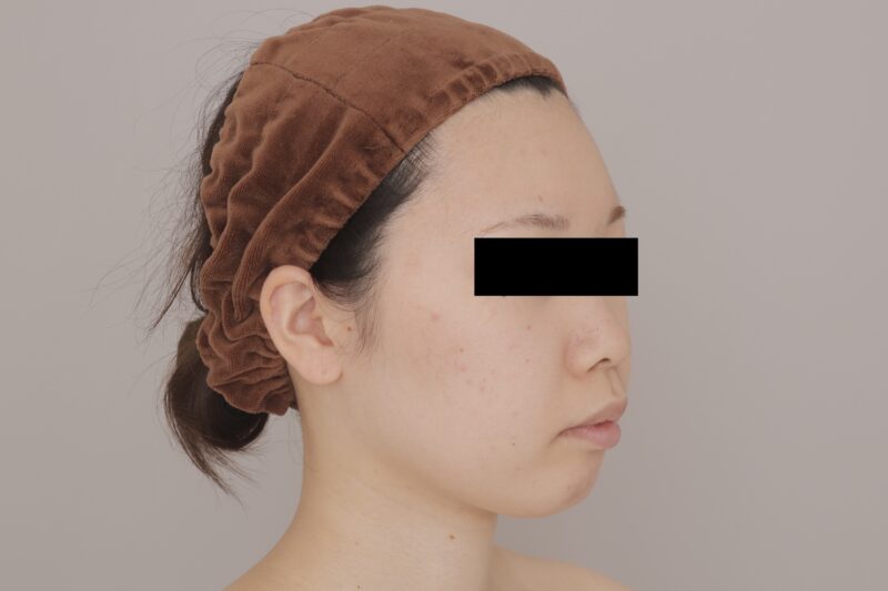 ベイザー脂肪吸引(3ヶ月経過:23)の術前写真