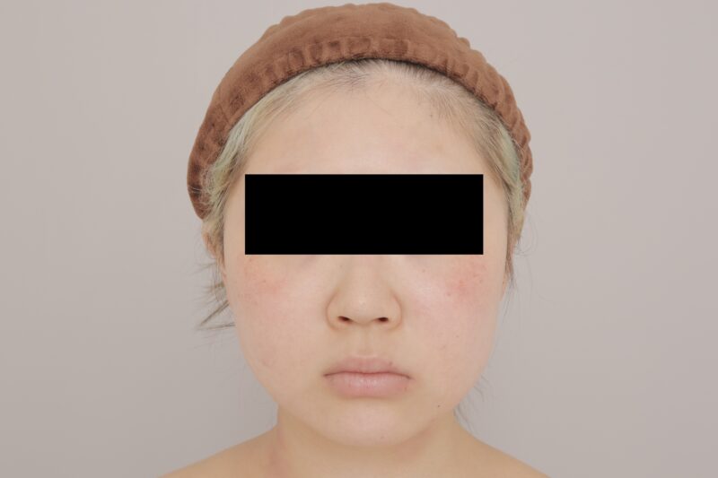 ベイザー脂肪吸引(1ヶ月経過:19)の術前写真