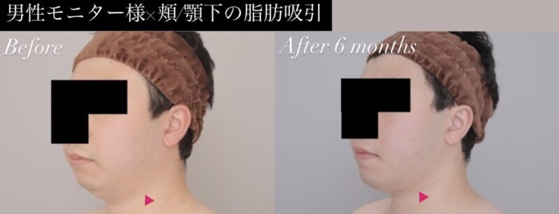 ●【頬＋顎下】20代男性 163cm 64kgのモニター様
