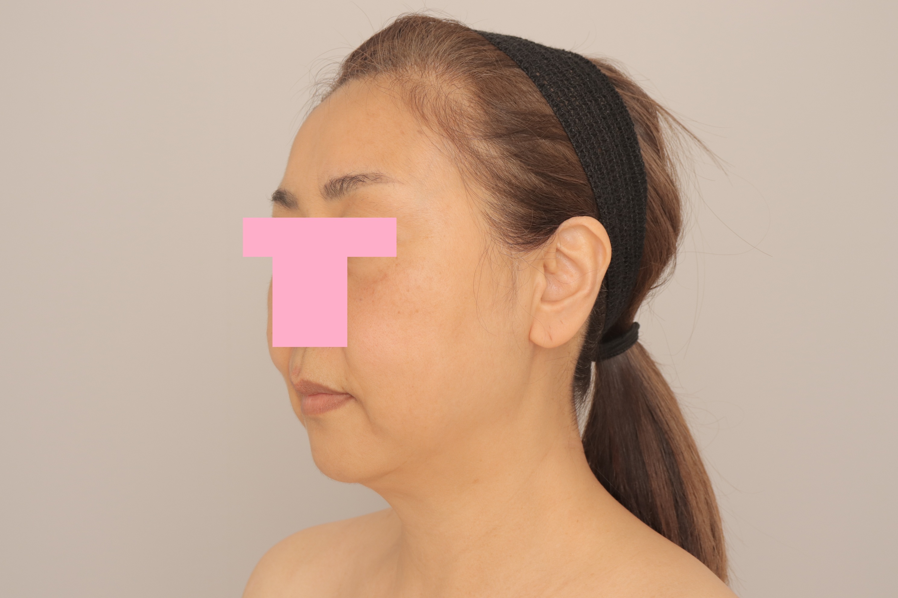 ベイザー脂肪吸引（3か月経過：57）の術前写真