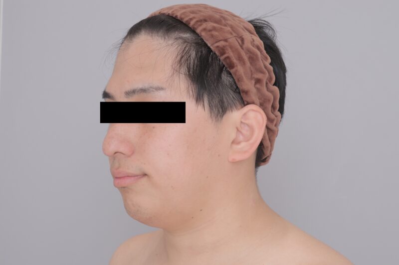 ベイザー脂肪吸引（3ヶ月経過：31）の術前写真