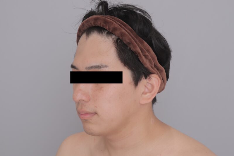 ベイザー脂肪吸引（3ヶ月経過：31）の術後写真